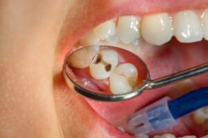 Le guide complet de la prévention des caries dentaires 
